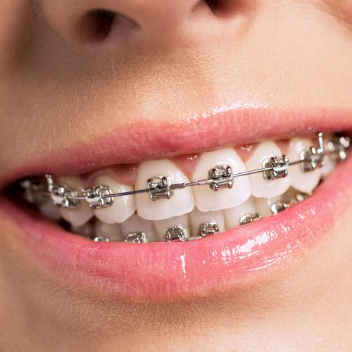 Trattamento Denti sporgenti Lousanne - Mercuri Orthodontie